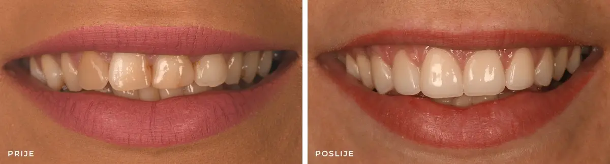 Estetska-stomatologija_KM_prije_poslije