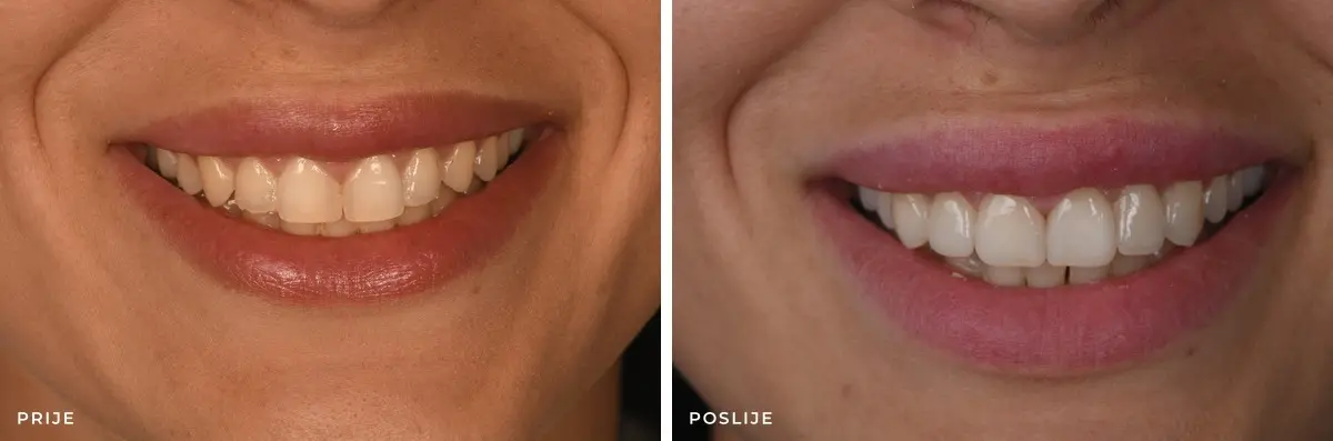 Estetska-stomatologija_RF_prije_poslije
